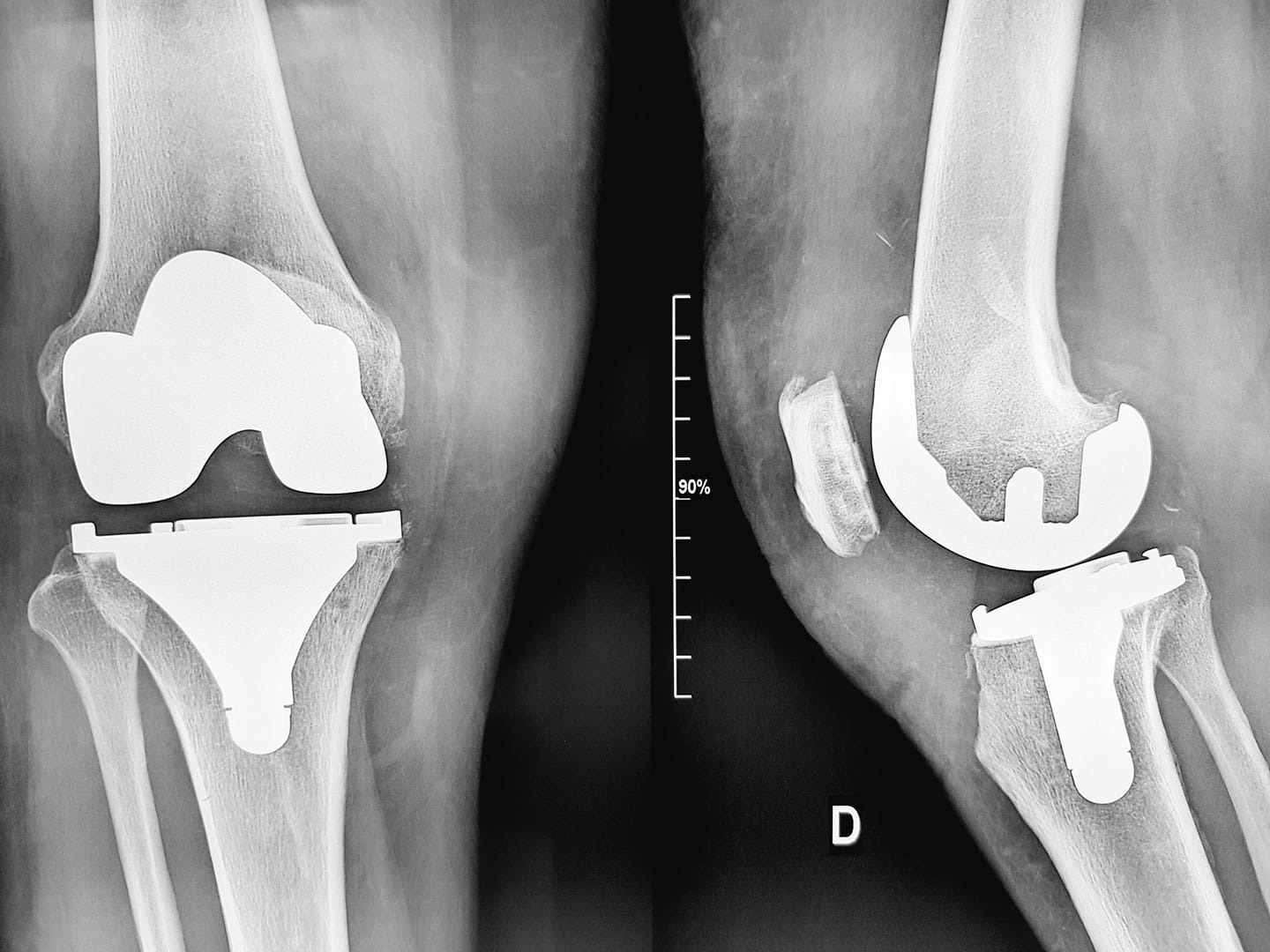 قطر تعيد لشابة عشرينية القدرة على المشي
