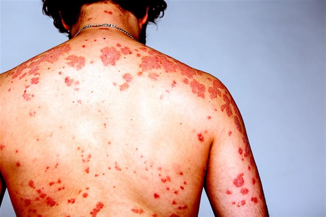 أكثر 8 دول عربية إصابة بفيروس الإيدز